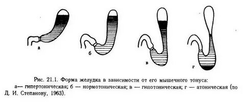 Гастроптоз 1
