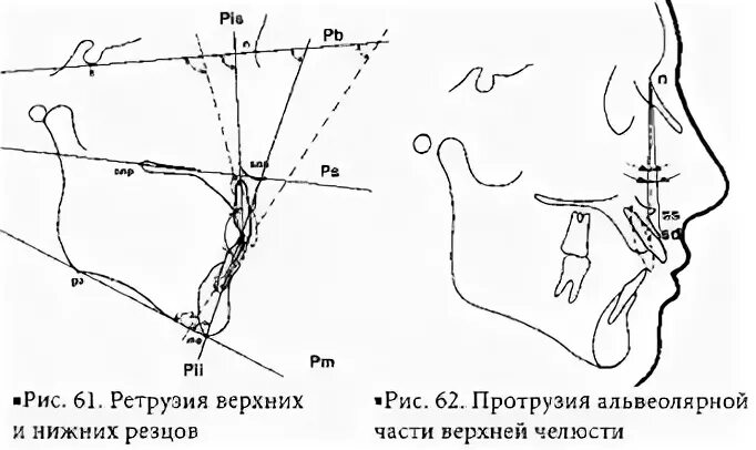 ретрузия верхних резцов