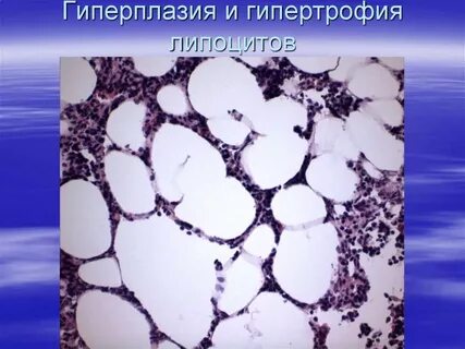 Гиперплазия 1 степени