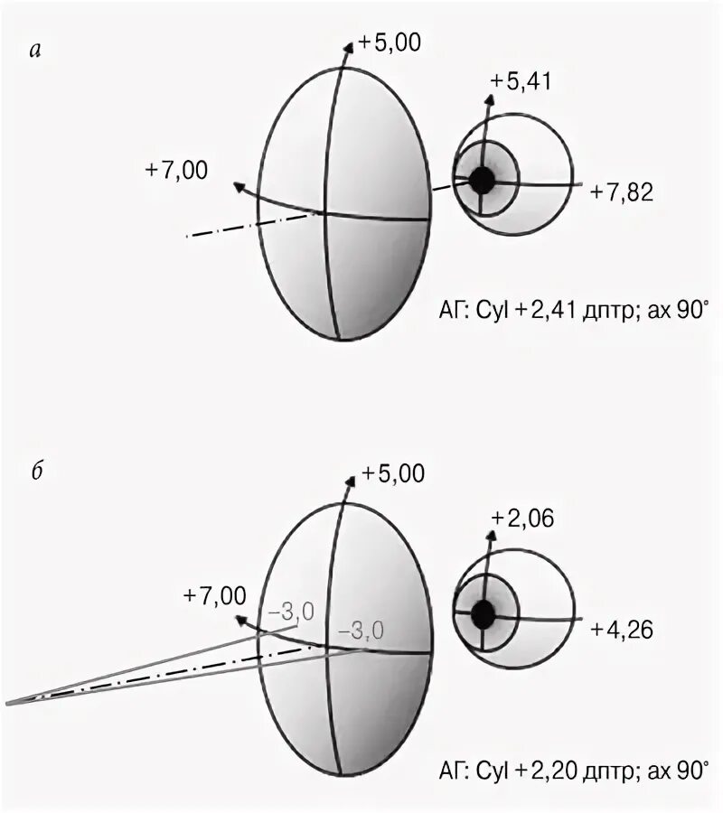 Линзы для глаз схема SPH -0,5. Cyl AX В офтальмологии. Астигматизм Cyl. Cyl 0.5 астигматизм. 0.5 дптр