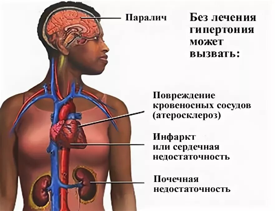 Почечная гипертензия. Последствия гипертонии. Нефрогенная гипертония.