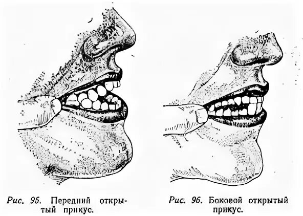 Артикуляторная дислалия. Нарушения строения артикуляционного аппарата. Прикус челюсти анатомия. Механическая дислалия прикус.