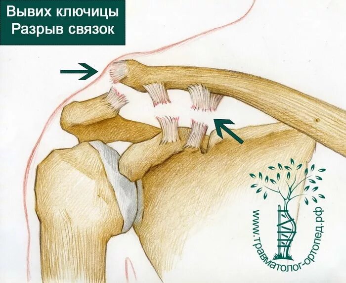 Обойтись разрыв. Перелом акс плечевого сустава. Неполный вывих акромиального конца ключицы. Разрыв связок плечевого сустава акс.