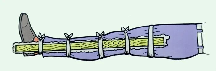 Техника наложения шин при переломах. Перелом голени иммобилизация. Иммобилизация при переломе костей голени. Иммобилизация подручными средствами при переломах.