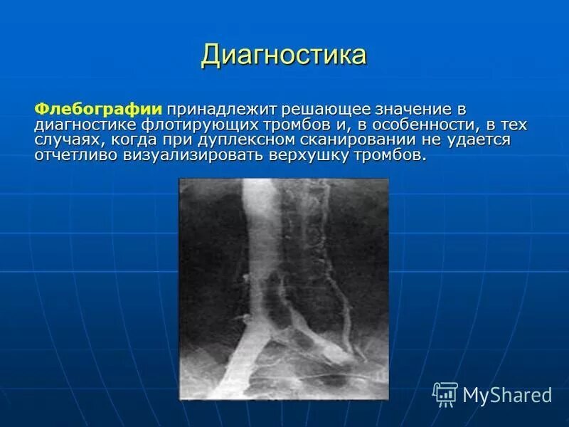 Диагностика тромбов. Флотирующий илеофеморальный тромбофлебит. Флотирующий венозный тромбоз. Острый флотирующий тромбоз глубоких вен. Илеофеморальный венозный тромбоз.