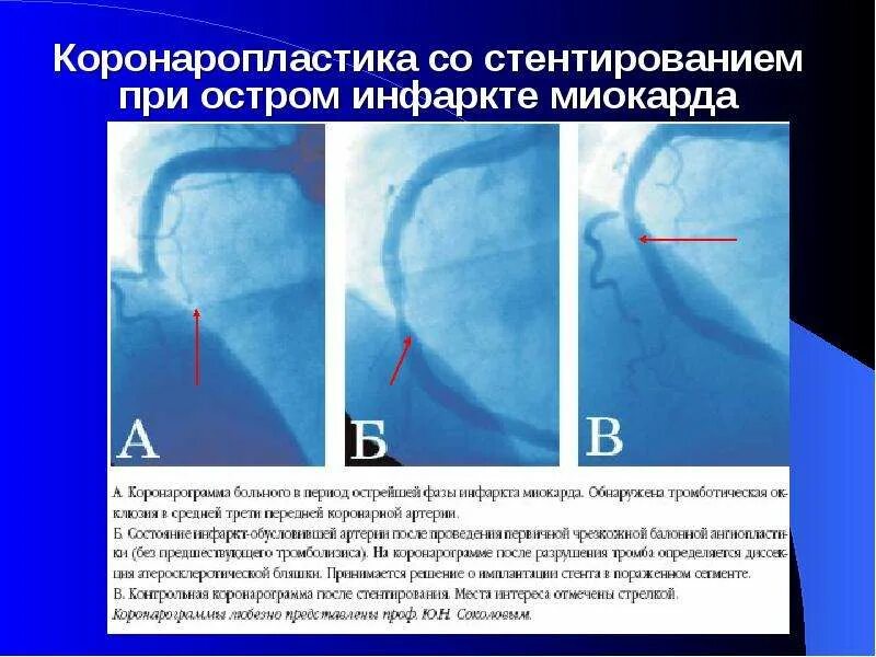 Стенд после инфаркта. Инфаркт миокарда операция стентирование. стент при инфаркте миокарда. стентирование острого инфаркта. коронарное стентирование при инфаркте миокарда.