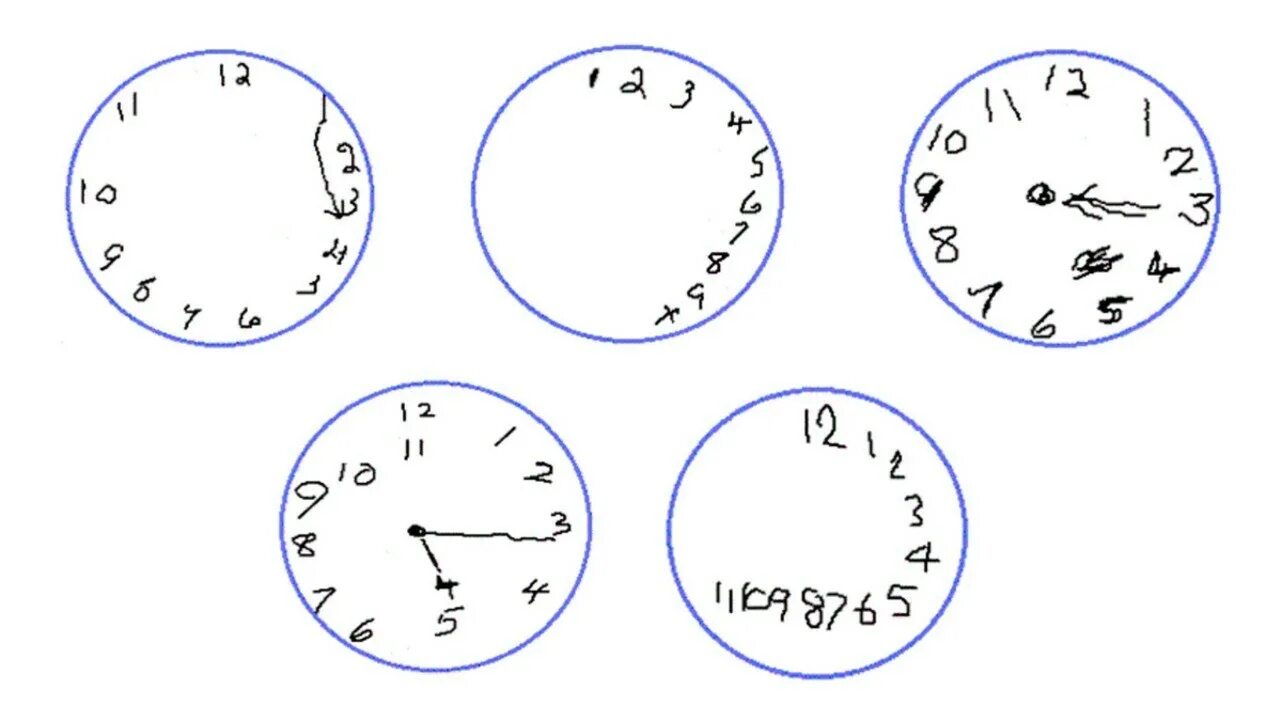 Шкала деменции. Тест часы для деменции интерпретация. Тест рисования часов при деменции. Тест рисования часов при болезни Альцгеймера. Тест рисования часов интерпретация.