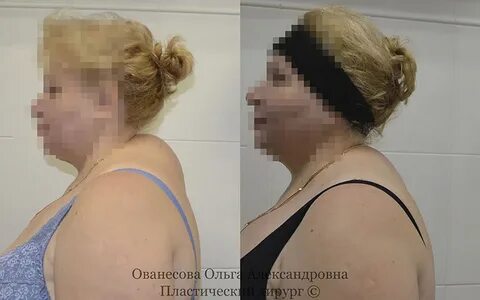 Липосакция холки