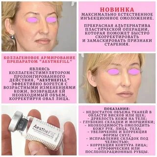 Инъекции полимолочной кислоты для лица