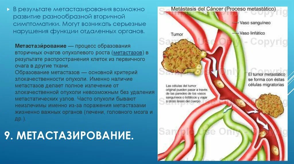 Признаки метастаз при раке. Процесс метастазирования. Метастазирование опухолей. Органы мишени метастазирования.