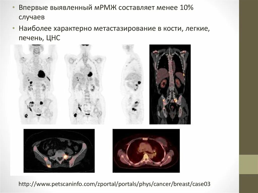 Метастазы при раке молочной железы симптомы. Метастазы в костях при рмж. метастазы в кости при рмж. метастазы в костях при онкологии груди.