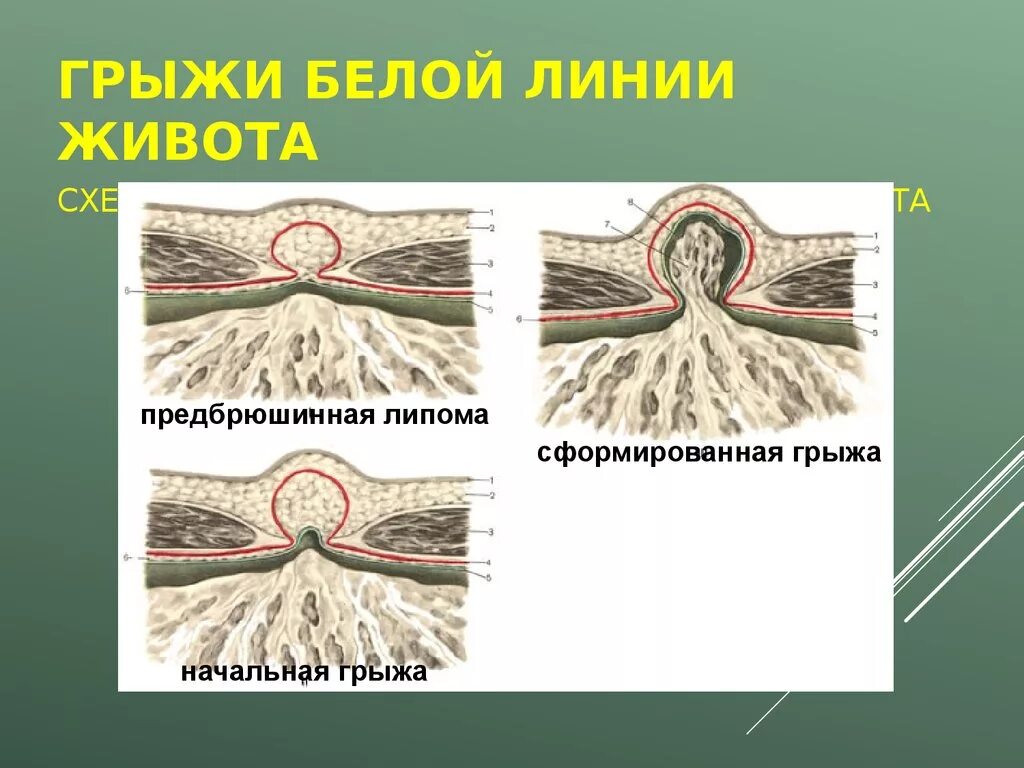 Беллиния. Грыжа предбрюшинной клетчатки. Грыжа белой линии живота. Грыжа на животе и белой линии живота.