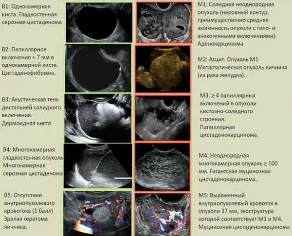 Киста яичника o rads. Кисты яичников классификация УЗИ. Цистаденомы яичника классификация. Папиллярная серозная цистаденома. Папиллярные опухоли яичников.