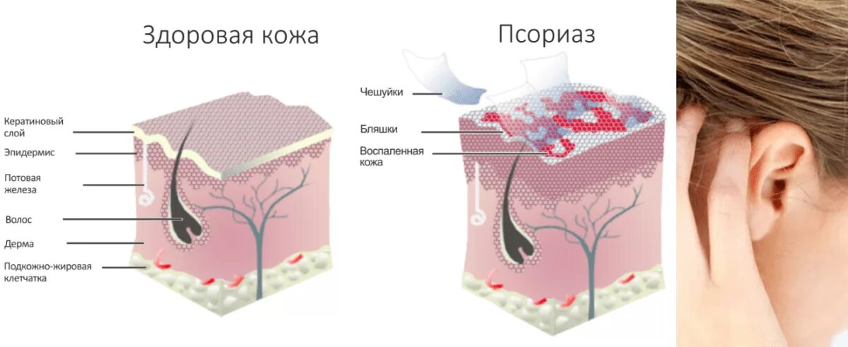 Причины ушного дерматита у людей и методы лечения