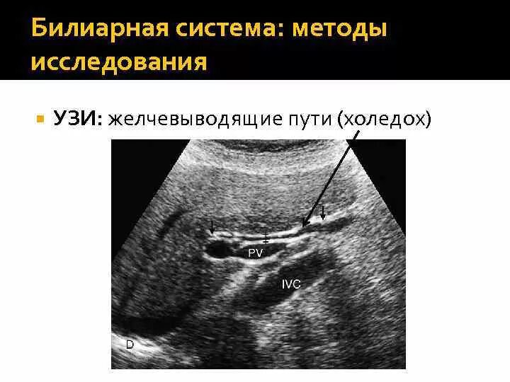 Желчный проток на УЗИ норма. Расширение общего желчного протока на УЗИ. Желчный проток холедох. Расширенный проток желчного пузыря.