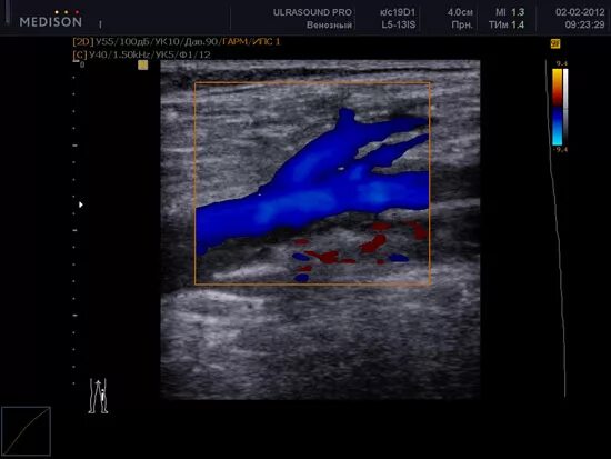 Дуплексное сканирование конечностей артерий. УЗДГ тромбофлебит нижних конечностей. Вены нижних конечностей УЗИ. Сафено-поплитеальное соустье на УЗИ. Узи вен тромбоз