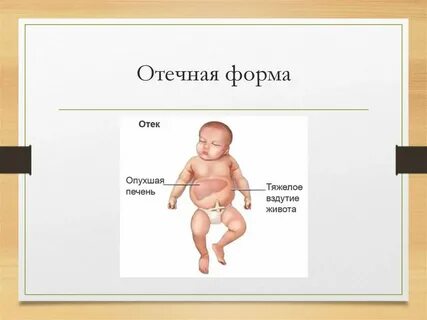 Отек плода