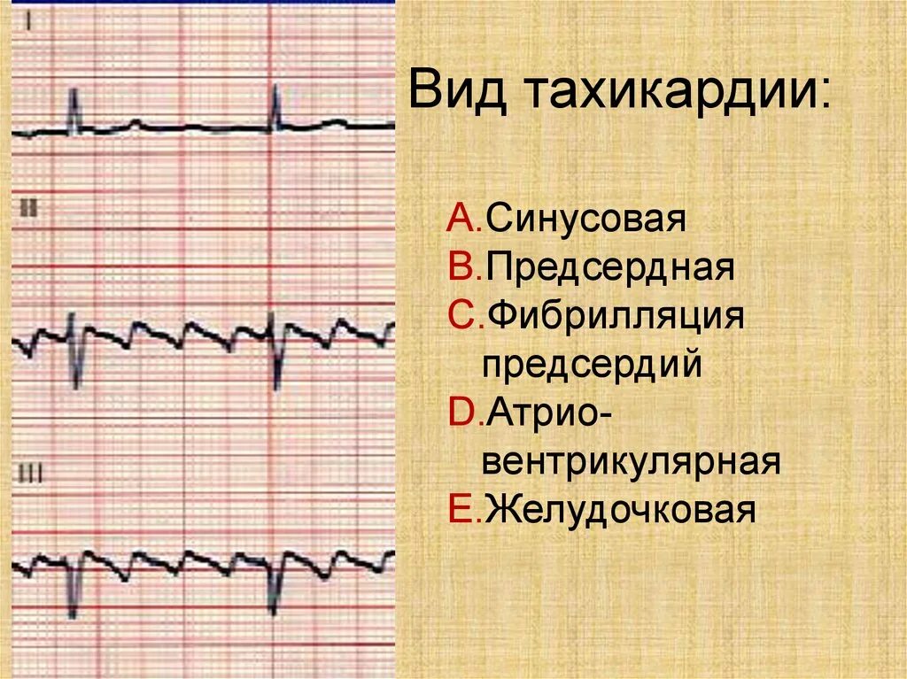 Тахикардия осложнения. ЭКГ при синусовой тахикардии. ЭКГ при предсердной тахикардии. Пробежка желудочковой тахикардии на ЭКГ. Синусоидальная желудочковая тахикардия.