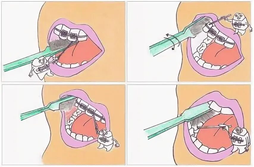 После чистки зубов можно ли пить чай. Чистить зубы с бреке ами. Гигиена полости рта с брекетами. Схема чистки зубов с брекетами.