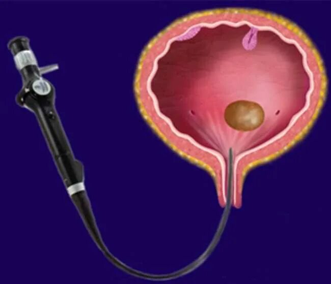 Удаление мочевого пузыря сколько. Опухоль мочевого пузыря цистоскопия. Уретроскопия мочевого пузыря. Цистолитотрипсия мочевого пузыря.