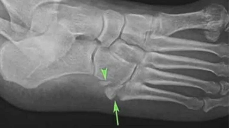 Перелом ладьевидной кости стопы рентген. Кубовидная кость стопы перелом. Кубовидная кость стопы рентген. Краевой перелом ладьевидной кости стопы.