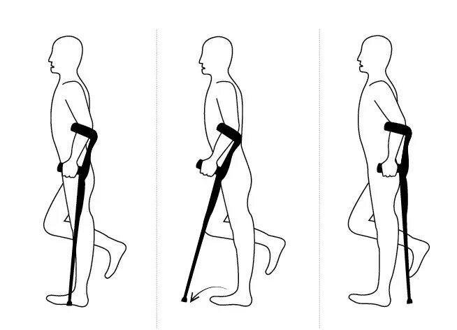 Костыли ампутация. Костыль с опорой под локоть схема. Ходьба на костылях. Костыли с опорой на локоть. Костыли с опорой на предплечье.