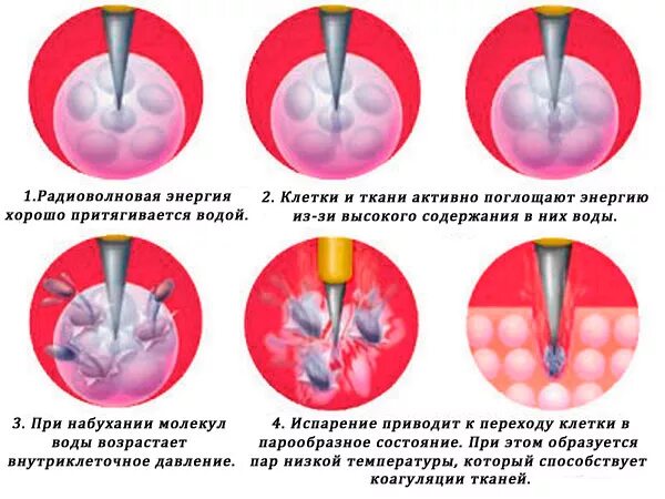 Ограничения после коагуляции