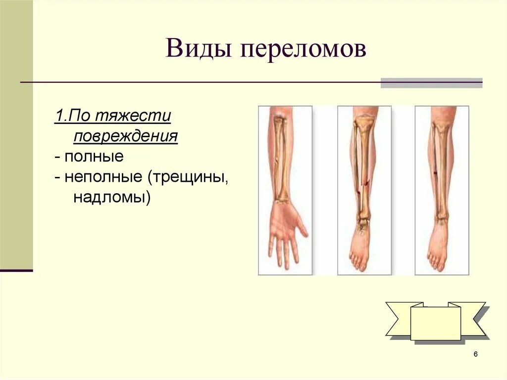 Виды переломов по тяжести повреждений.