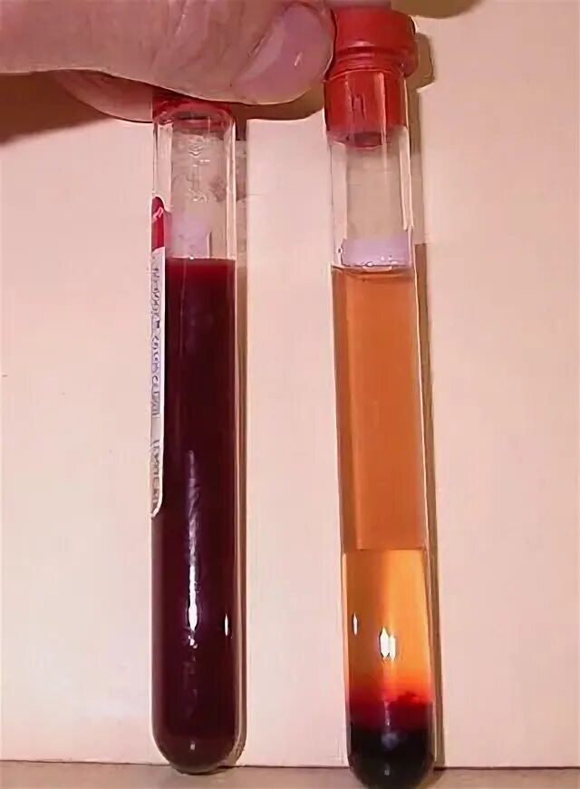 Почему мочится кровью. Urine bloody. что делать мочишься кровью.
