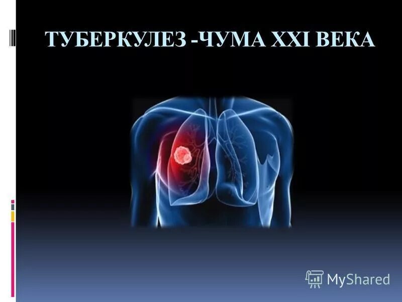 Чума это туберкулез. Бубонная чума возбудитель. Особо опасные инфекции чума холера сибирская язва. Чума это туберкулез. Чума это туберкулез.