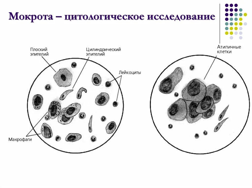 Эпителий в мокроте микроскопия. Мокрота атипичные клетки микроскопия. Клеточные элементы мокроты микроскопия. Мерцательный эпителий в мокроте микроскопия.