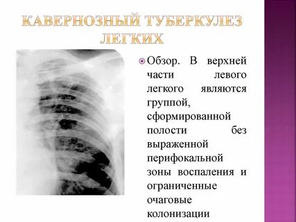 Разрешение инфильтрации в легких