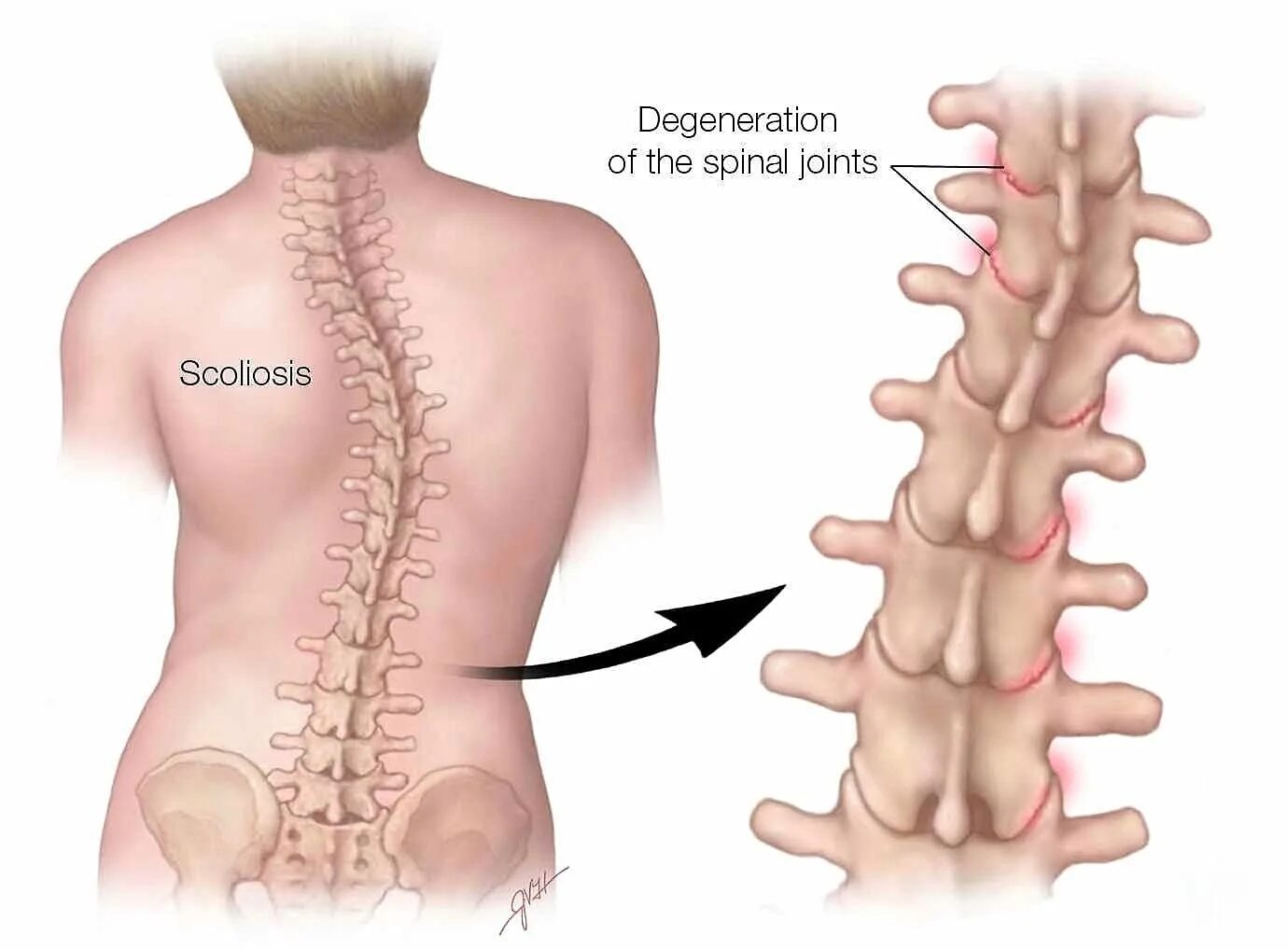 Болезни спины и позвоночника. Нарушение позвоночника. Сколиоз позвоночника. Искривление позвоночника и смещение позвонков.