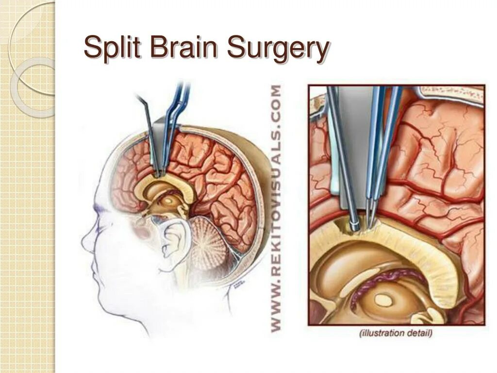 Split brain. Операция на головном мозге. Операция через нос головного мозга. Залезть в мозг через нос. Фото после удаления опухоли гипофиза через нос.