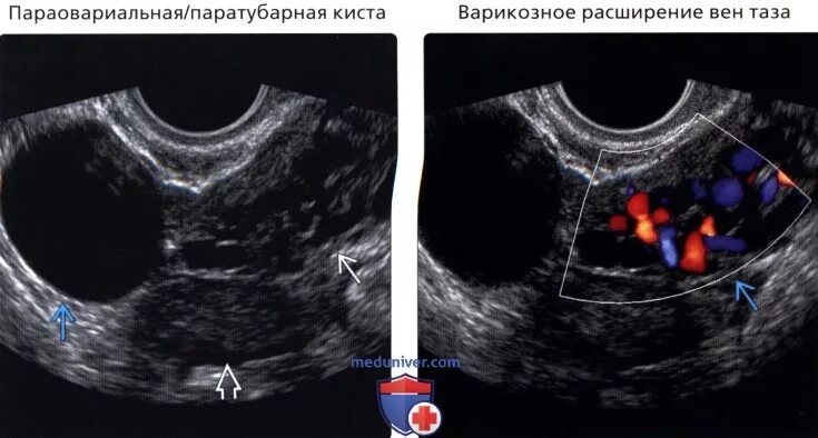 Параовариальная эндометриоидная киста. Паратубарная киста киста. Пароовальная киста яичника. Параовариальная киста яичника клиника. Киста яичника с перегородками