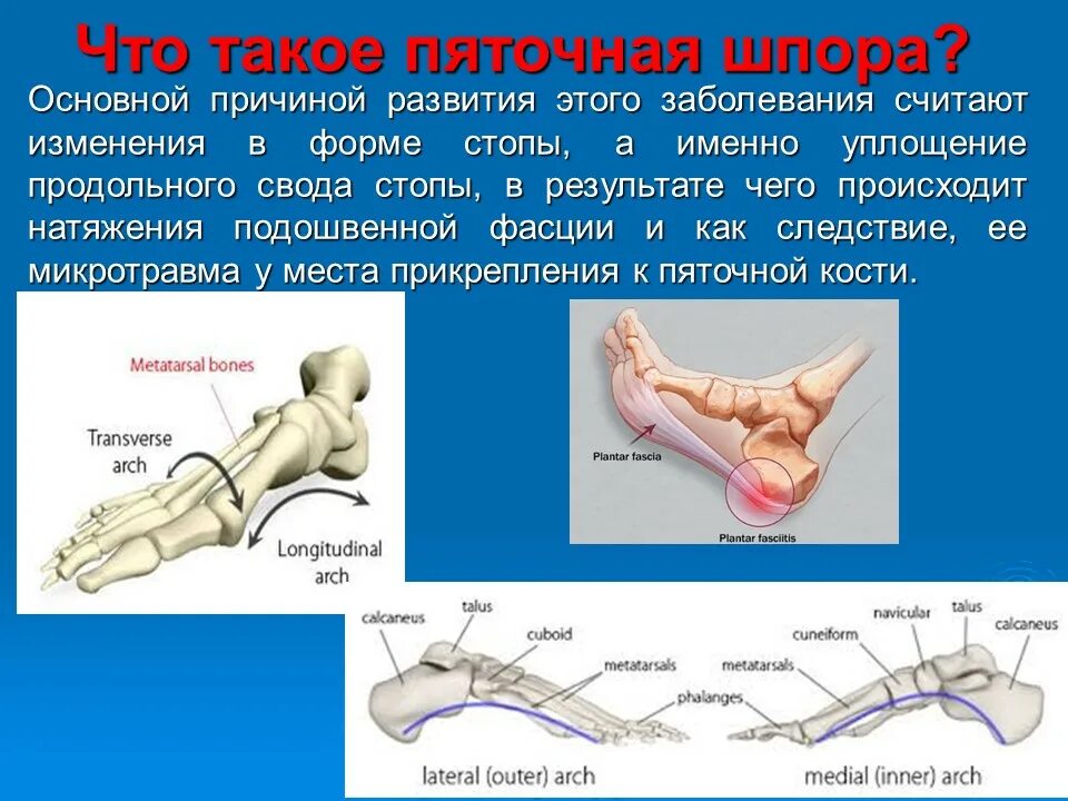 рентген описание пяточных шпор. пяточная шпора описание. задняя пяточная шпора рентген. как лечить пяточную шпору. пяточная шпора описание.