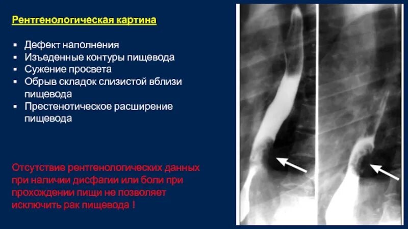 Просвет пищевода