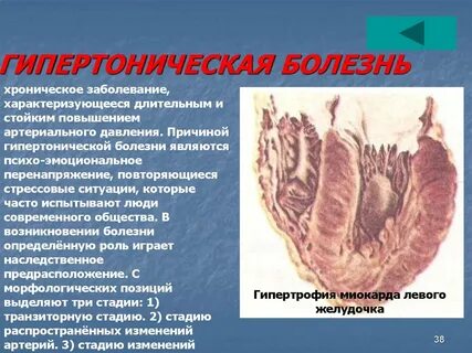Гипертоническое поражение сердца