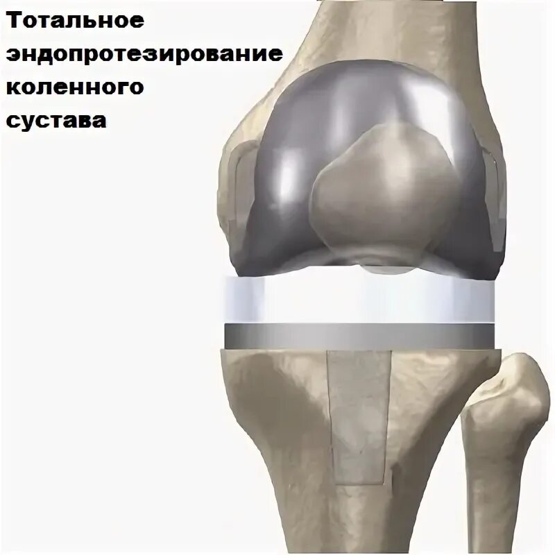 Эндопротезирование коленного после операции сколько болит. Maxx orthopedic эндопротез коленного. эндопротез коленного сустава операция. эндопротезирование коленного сустава ход операции. тотальное эндопротезирование коленного сустава.