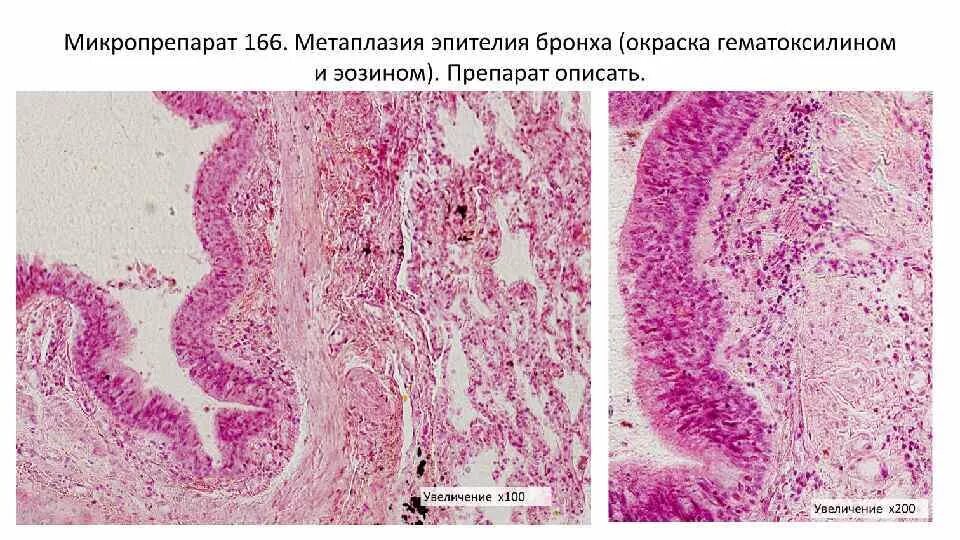 Метаплазия эпителия бронха микропрепарат. Хронический деформирующий бронхит микропрепарат. Метаплазия эпителия бронхов. Плоскоклеточная метаплазия эпителия бронхов. Группы клеток метаплазированного