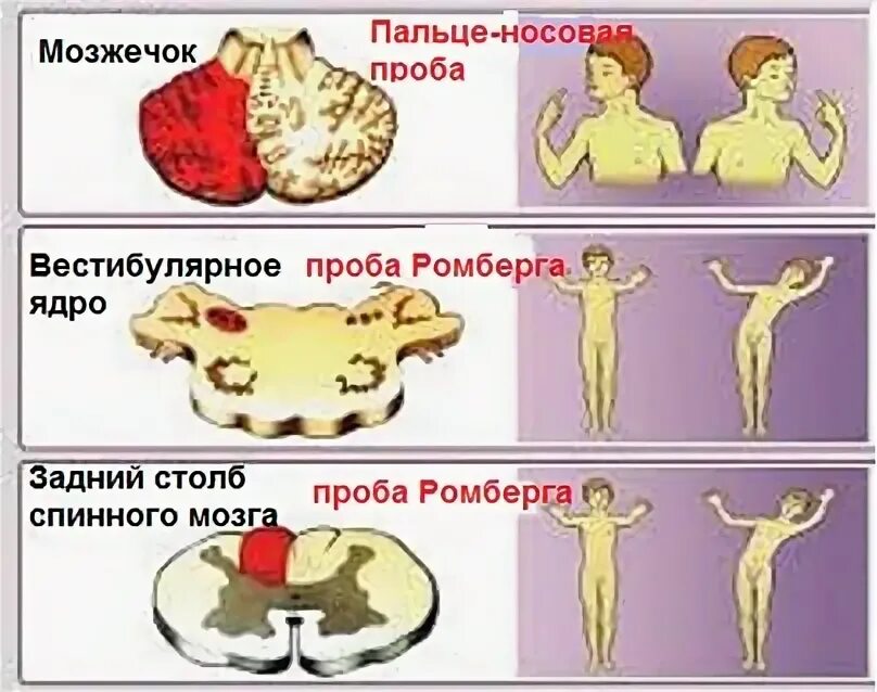 Вестибулоатактический синдром. Степени вестибуло атактического синдрома. Мозжечковая пальце носовая проба.