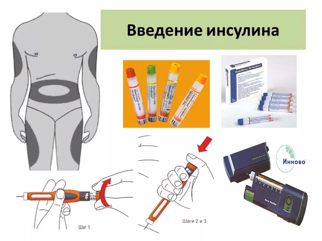 Алгоритм введения подкожной инъекции инсулина. Особенности введения инсулина подкожно. Алгоритм введения инсулина подкожно шприцем. Внутрикожная инъекция инсулин.