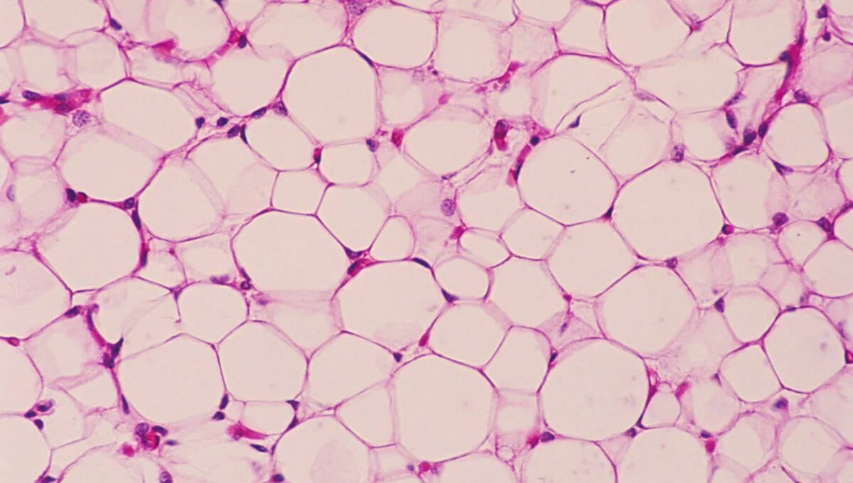 Scientists use nanoparticles to crush lingering fat cells