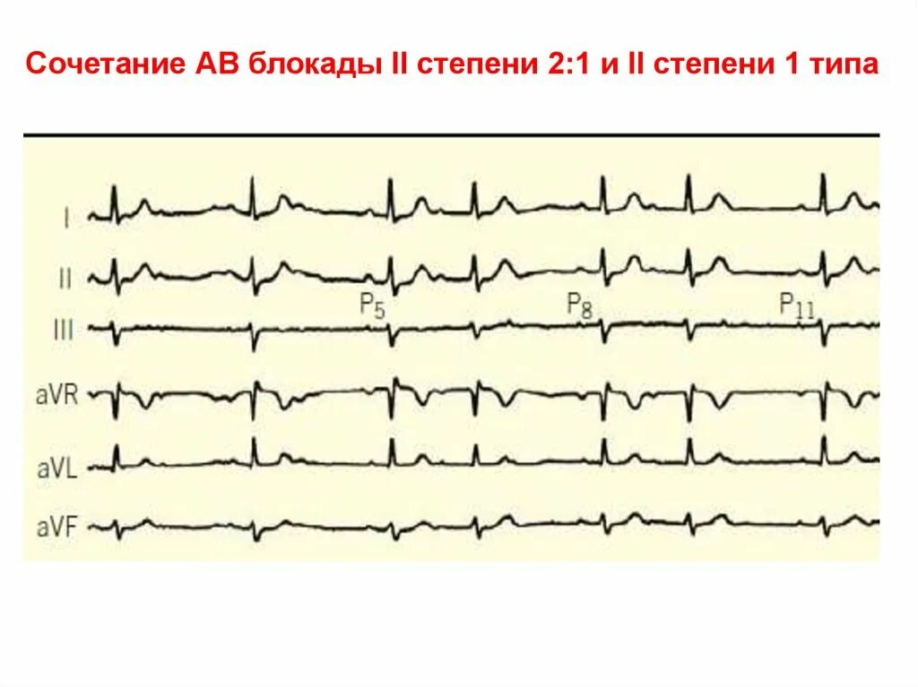 Са блокада 1 степени. Синоатриальная блокада 1 степени на ЭКГ. Синоатриальная блокада 2 степени 2:1. Са блокада 2 степени на ЭКГ. Са блокада II степени 1 типа.