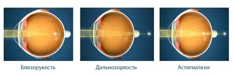 Коррекция зрения при астигматизме отзывы