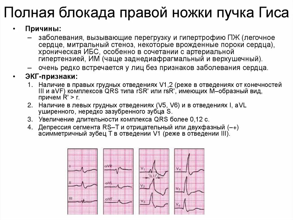 Блокада инструкция. Блокада правой ножки пучка Гиса на ЭКГ. Блокада левой и правой ножки пучка Гиса. Блокада ножек пучка Гиса причины. Блокада правой ножки пучка Гиса клиника.