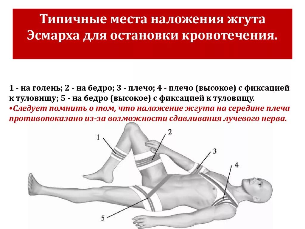 Артериальное кровотечение нижних конечностей. Места наложения кровоостанавливающего жгута. Наложение жгута при артериальном кровотечении. Наложение жгута при кровотечении хирургия. Типичные места наложения жгута при артериальном кровотечении.