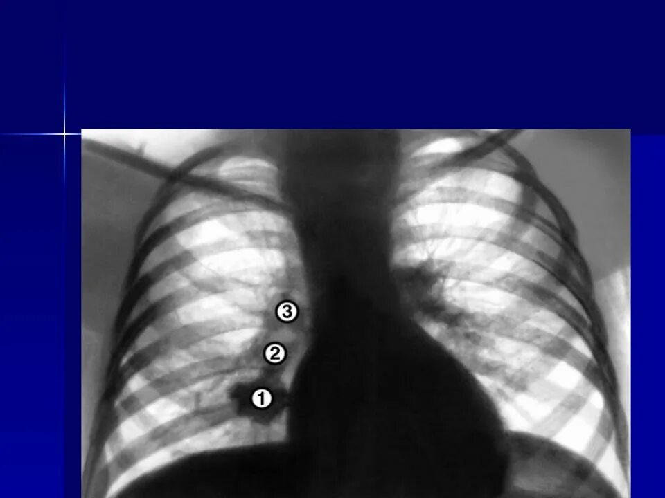 Первичный туберкулезный комплекс на рентгенограмме. Лимфоузлы средостения рентген. Лимфоузлы средостения на флюорографии. Туберкулез лимфоузлов легких рентген.