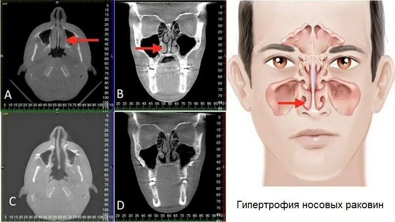 Вазотомия лазером. Вазотомия носовых раковин. Вазомоторный ринит операция. Латеропексия носовых раковин. Вазотомия и конхотомия носовых раковин.