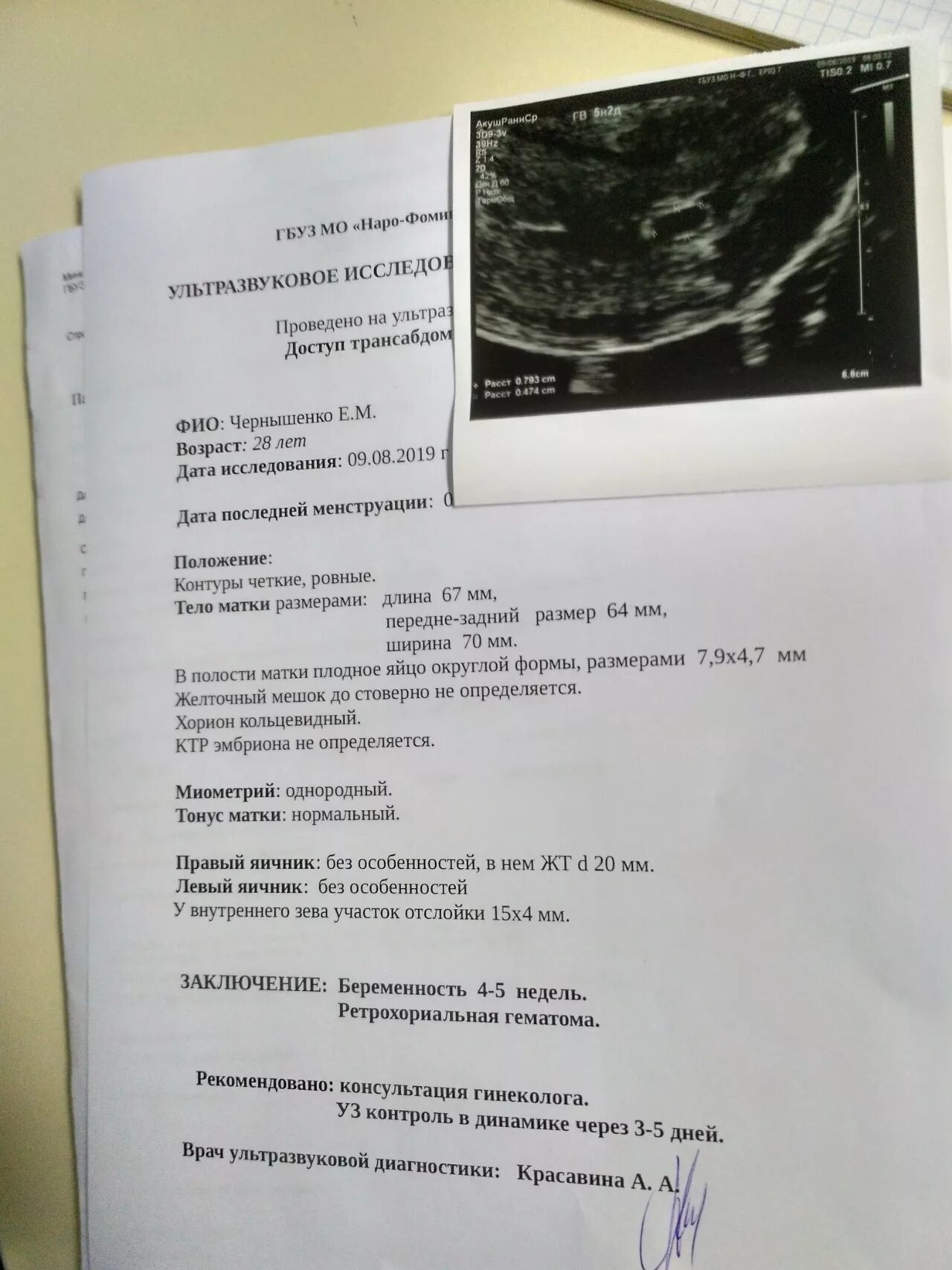 Плодное яйцо желточный мешочек. Узи 6 недель беременности желточный мешок. желточный мешок на узи 4 недели. узи желточный мешок 5 неделя.